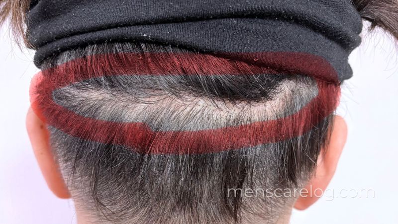 FUT植毛から20年後の後頭部の傷跡・採取部全体