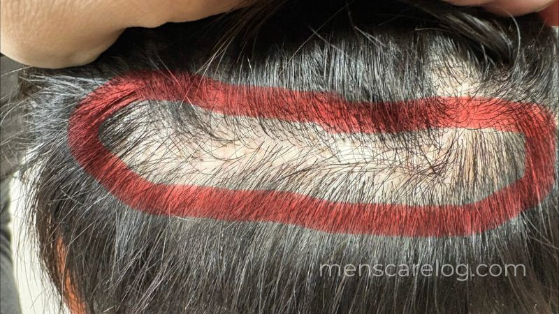 FUT植毛の縫合跡クローズアップ・ジグザグの赤いライン